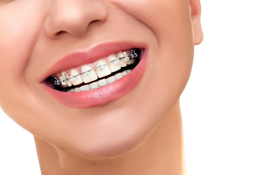 Ortodoncia-brackets