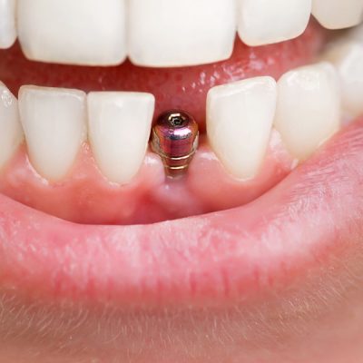 implante-dental.jpg